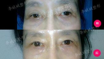 去眼袋手术教程视频,告别眼部困扰